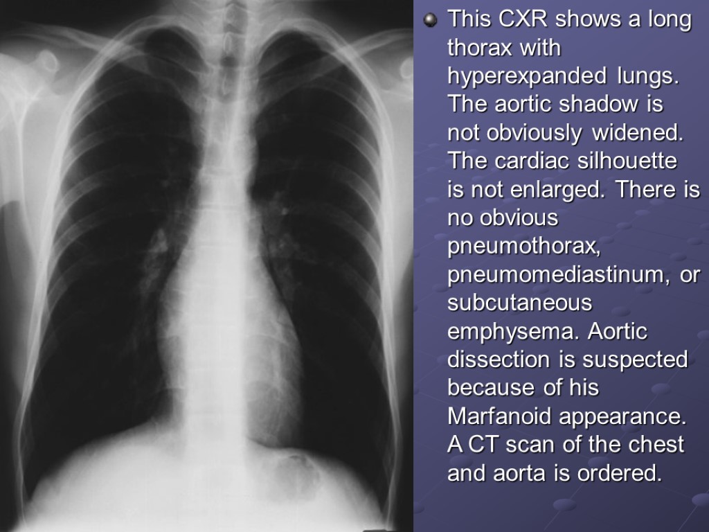 This CXR shows a long thorax with hyperexpanded lungs. The aortic shadow is not